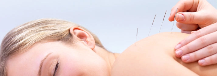 Chiropractic Allen TX Dry Needling Dry needling patient.